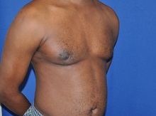 Male Breast Reduction After Photo by Jerry Weiger Chang, MD, FACS; Flushing, NY - Case 35028