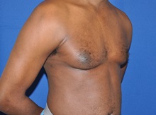 Male Breast Reduction Before Photo by Jerry Weiger Chang, MD, FACS; Flushing, NY - Case 35028