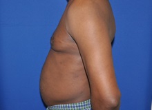 Male Breast Reduction After Photo by Jerry Weiger Chang, MD, FACS; Flushing, NY - Case 35028