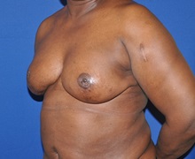Breast Reconstruction After Photo by Jerry Weiger Chang, MD, FACS; Flushing, NY - Case 35030