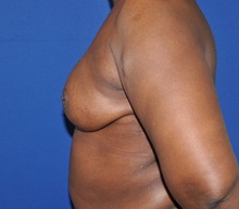 Breast Reconstruction After Photo by Jerry Weiger Chang, MD, FACS; Flushing, NY - Case 35030