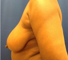 Breast Reconstruction Before Photo by Jerry Weiger Chang, MD, FACS; Flushing, NY - Case 35030