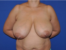 Breast Reduction Before Photo by Jerry Weiger Chang, MD, FACS; Flushing, NY - Case 35031