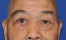 Eyelid Surgery After Photo by Jerry Weiger Chang, MD, FACS; Flushing, NY - Case 35032