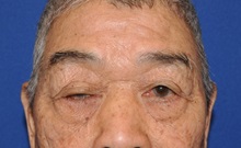 Eyelid Surgery Before Photo by Jerry Weiger Chang, MD, FACS; Flushing, NY - Case 35032