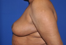Breast Reduction After Photo by Jerry Weiger Chang, MD, FACS; Flushing, NY - Case 35033