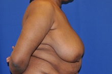 Breast Reduction Before Photo by Jerry Weiger Chang, MD, FACS; Flushing, NY - Case 35033