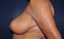 Breast Reduction After Photo by Jerry Weiger Chang, MD, FACS; Flushing, NY - Case 35034