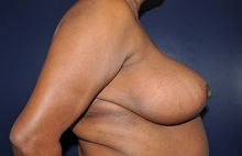 Breast Reduction After Photo by Jerry Weiger Chang, MD, FACS; Flushing, NY - Case 35034
