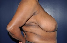 Breast Reduction Before Photo by Jerry Weiger Chang, MD, FACS; Flushing, NY - Case 35034