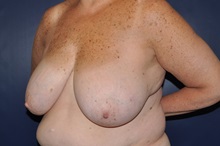 Breast Reconstruction Before Photo by Jerry Weiger Chang, MD, FACS; Flushing, NY - Case 36688