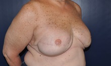 Breast Reconstruction After Photo by Jerry Weiger Chang, MD, FACS; Flushing, NY - Case 36688