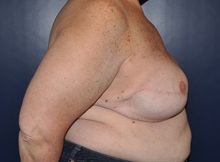 Breast Reconstruction After Photo by Jerry Weiger Chang, MD, FACS; Flushing, NY - Case 36688
