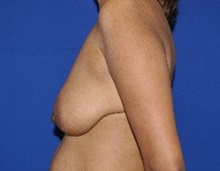 Breast Reconstruction Before Photo by Jerry Weiger Chang, MD, FACS; Flushing, NY - Case 36689