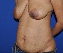 Tummy Tuck Before Photo by Jerry Weiger Chang, MD, FACS; Flushing, NY - Case 36690