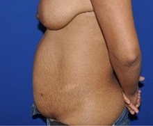 Tummy Tuck Before Photo by Jerry Weiger Chang, MD, FACS; Flushing, NY - Case 36690