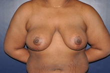 Breast Reduction After Photo by Jerry Weiger Chang, MD, FACS; Flushing, NY - Case 36694