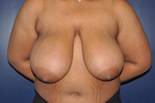Breast Reduction Before Photo by Jerry Weiger Chang, MD, FACS; Flushing, NY - Case 36694
