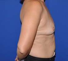 Breast Augmentation Before Photo by Jerry Weiger Chang, MD, FACS; Flushing, NY - Case 36697