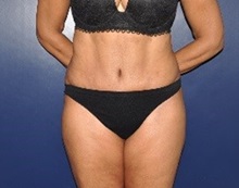 Tummy Tuck After Photo by Jerry Weiger Chang, MD, FACS; Flushing, NY - Case 36698