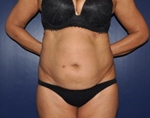 Tummy Tuck Before Photo by Jerry Weiger Chang, MD, FACS; Flushing, NY - Case 36698