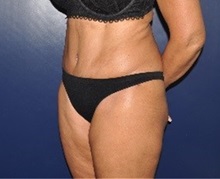 Tummy Tuck After Photo by Jerry Weiger Chang, MD, FACS; Flushing, NY - Case 36698