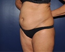 Tummy Tuck Before Photo by Jerry Weiger Chang, MD, FACS; Flushing, NY - Case 36698