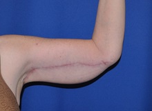 Arm Lift After Photo by Jerry Weiger Chang, MD, FACS; Flushing, NY - Case 36699