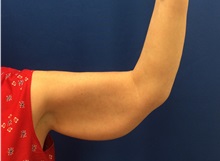 Arm Lift Before Photo by Jerry Weiger Chang, MD, FACS; Flushing, NY - Case 36699