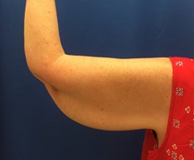 Arm Lift Before Photo by Jerry Weiger Chang, MD, FACS; Flushing, NY - Case 36699