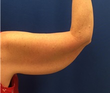 Arm Lift Before Photo by Jerry Weiger Chang, MD, FACS; Flushing, NY - Case 36699