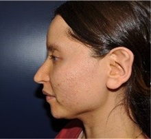 Rhinoplasty After Photo by Jerry Weiger Chang, MD, FACS; Flushing, NY - Case 36700