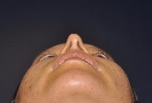 Rhinoplasty After Photo by Jerry Weiger Chang, MD, FACS; Flushing, NY - Case 36700