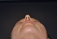 Rhinoplasty Before Photo by Jerry Weiger Chang, MD, FACS; Flushing, NY - Case 36700