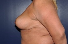 Breast Reduction After Photo by Jerry Weiger Chang, MD, FACS; Flushing, NY - Case 36701