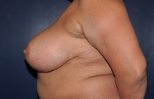 Breast Reduction Before Photo by Jerry Weiger Chang, MD, FACS; Flushing, NY - Case 36701