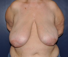 Breast Reconstruction Before Photo by Jerry Weiger Chang, MD, FACS; Flushing, NY - Case 41832