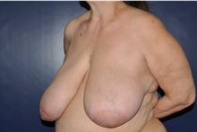 Breast Reconstruction Before Photo by Jerry Weiger Chang, MD, FACS; Flushing, NY - Case 41832