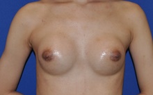 Breast Augmentation After Photo by Jerry Weiger Chang, MD, FACS; Flushing, NY - Case 41834