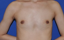 Breast Augmentation Before Photo by Jerry Weiger Chang, MD, FACS; Flushing, NY - Case 41834