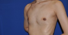 Breast Augmentation Before Photo by Jerry Weiger Chang, MD, FACS; Flushing, NY - Case 41834
