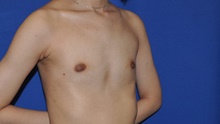 Breast Augmentation Before Photo by Jerry Weiger Chang, MD, FACS; Flushing, NY - Case 41834