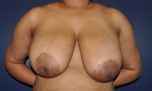 Breast Reduction Before Photo by Jerry Weiger Chang, MD, FACS; Flushing, NY - Case 41835