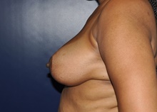 Breast Reduction After Photo by Jerry Weiger Chang, MD, FACS; Flushing, NY - Case 41835