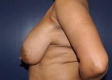Breast Reduction Before Photo by Jerry Weiger Chang, MD, FACS; Flushing, NY - Case 41835