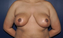 Breast Reduction After Photo by Jerry Weiger Chang, MD, FACS; Flushing, NY - Case 41839