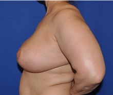 Breast Reduction After Photo by Jerry Weiger Chang, MD, FACS; Flushing, NY - Case 41841