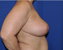 Breast Reduction After Photo by Jerry Weiger Chang, MD, FACS; Flushing, NY - Case 41841