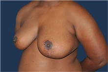 Breast Reduction After Photo by Jerry Weiger Chang, MD, FACS; Flushing, NY - Case 41843