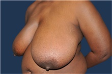 Breast Reduction Before Photo by Jerry Weiger Chang, MD, FACS; Flushing, NY - Case 41843